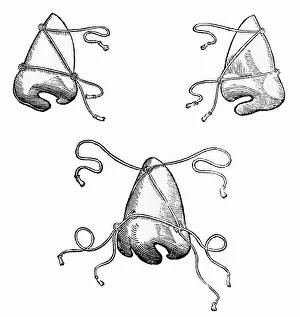 Operating Prints: Tagliacozzi's Post-Operative Nose Masks, 1500s