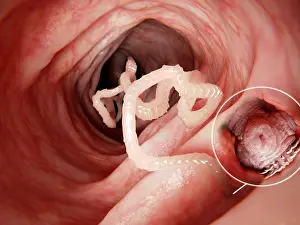 Pathological Prints: Tapeworm in human intestine