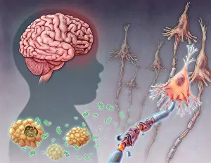 2016 Prints: Tay-sachs Disease, illustration