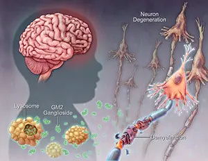 Genetics Prints: Tay-sachs Disease, illustration