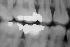 Test Prints: Teeth With Fillings, X-ray