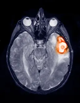 Diagnosis Prints: Temporoparietal brain hemorrhage, MRI