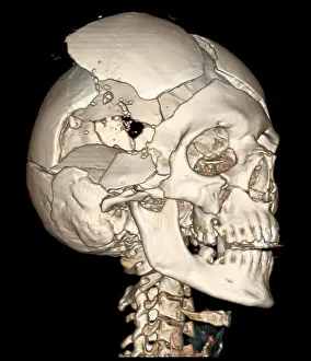 Medical Prints: Three-Dimensional CT Reconstruction, Skull with Bullet Wounds