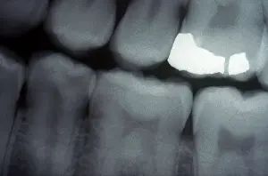 Test Prints: Tooth With Filling, X-ray