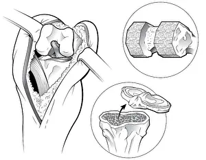 Knee Prints: Total Knee Replacement