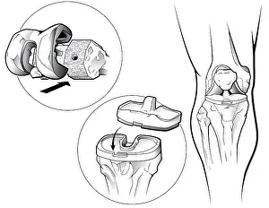 Knee Prints: Total Knee Replacement (Prosthetic)