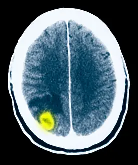 2004 Prints: Toxoplasmosis of the Brain