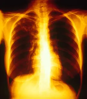 Condition Prints: Tuberculosis, X-ray