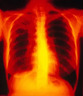 Test Prints: Tuberculosis, X-ray
