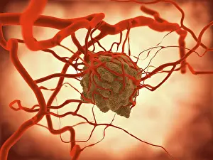 Medical Prints: Tumor, artwork