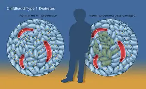 Type 1 Diabetes in Childhood