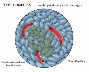 Islets Prints: Type 1 Diabetes, Damaged Islets of Langerhans Cells