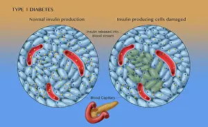 Type 1 Diabetes, Islets of Langerhans