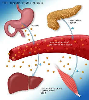 High Prints: Type I diabetes microbiology diagram of insulin