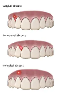 Abscess Prints: Types of Dental Abscesses, Illustration