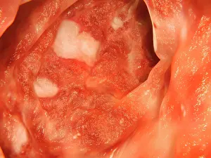 Pathological Prints: Ulcerative colitis, artwork
