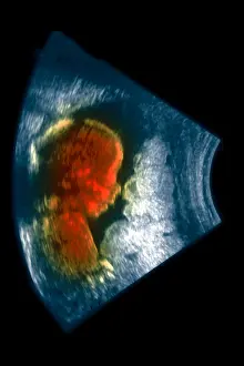 Diagnosis Prints: Ultrasound of a 5 month old fetus