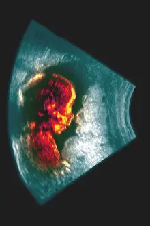 Diagnosis Prints: Ultrasound of a 5 month old fetus
