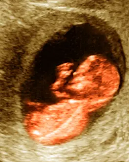 Trending: Ultrasound of a Healthy 12 Week Old Fetus, Medical Scan