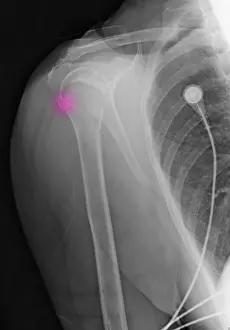 Break Prints: Upper Humerus Fracture, Osteoporosis