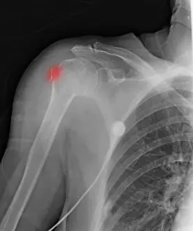 Break Prints: Upper Humerus Fracture, Osteoporosis
