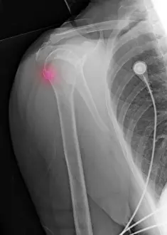 Diagnosis Prints: Upper Humerus Fracture, Osteoporosis