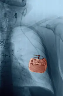 Device Prints: Vagus Nerve Stimulator, Epilepsy, X-Ray