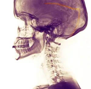 Treatment Prints: Ventricular Shunt for the Treatment of Hydrocephalus