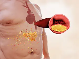 Pathological Prints: Visceral fat increases the risk of atherosclerosis and stroke