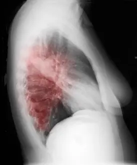Pneumoniae Prints: Walking Pneumonia