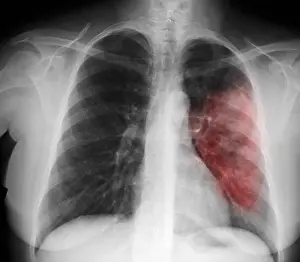 Bacteria Prints: Walking Pneumonia
