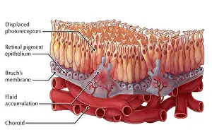 Pigment Prints: Wet AMD, Illustration