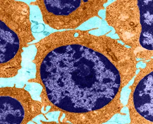Leukemia Prints: White Blood Cells in Leukemia (TEM)