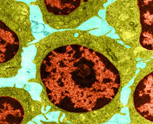 Leukemia Prints: White Blood Cells in Leukemia (TEM)
