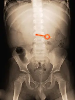 Object Prints: X-ray of Abdomen With Key