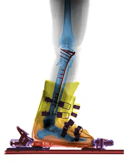 Sport Prints: X-ray of Broken Bones in Ski boot