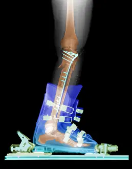 X Rays Prints: X-ray of Broken Bones in Ski boot