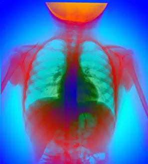 2003 Prints: X-ray of chest