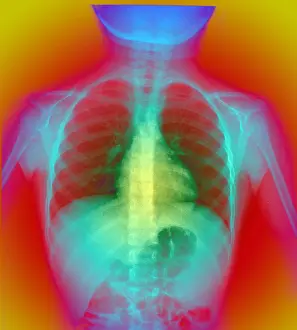 2003 Prints: X-ray of chest