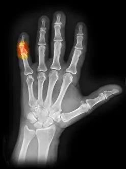 Hand Prints: X-ray of Crushed Finger