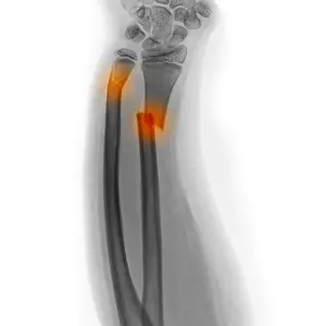 Injury Prints: X-ray of Fractured Forearm