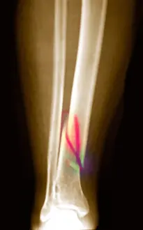 Radiographs Prints: X-ray of fractured tibia