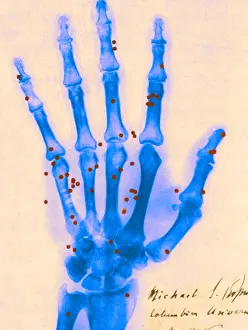 Michael Prints: X-ray of Gunshot in the Hand