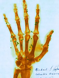 Shot Prints: X-ray of Gunshot in the Hand