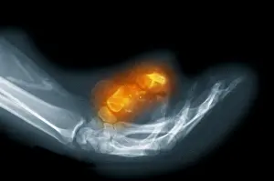 2004 Prints: X-Ray of a Gunshot Wound to the Hand