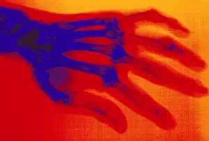 2004 Prints: X-ray of hand with rheumatoid arthritis