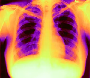 Chest Prints: X-ray of Heart and Lungs