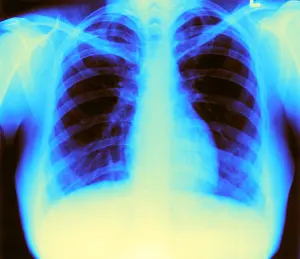 Chest Prints: X-ray of Heart and Lungs