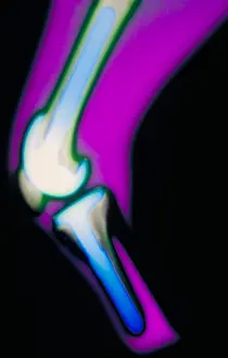 Test Prints: X-ray of knee replacement of a 38 year old female