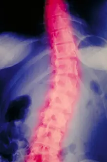 Part Prints: X-Ray. Scoliosis of spine